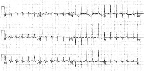 Normal Neonatal Ecg