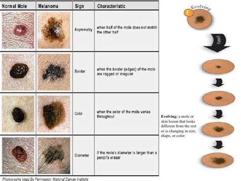 Malignant Melanoma Types