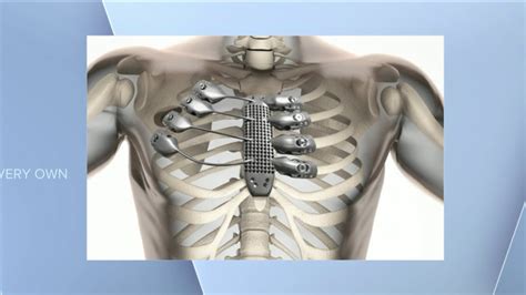 3d Printer Helps Create Titanium Rib Cage For Cancer Patient Wgn Tv