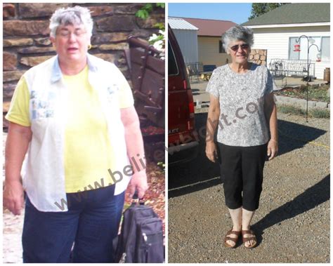 Carolyn S Medicare Paid Gastric Bypass Success Story Photos