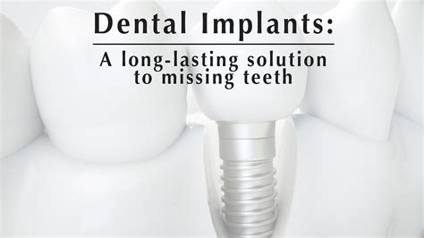 Common Questions About Dental Implants Answered Youtube