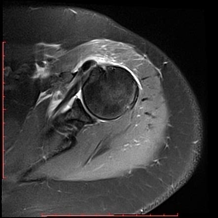 Calcific Tendonitis Of Subscapularis Tendon Radiology Case