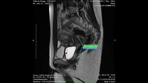 The Rouen Technique Disc Excision Of Large Mid Rectal Deep Endometriosis Youtube