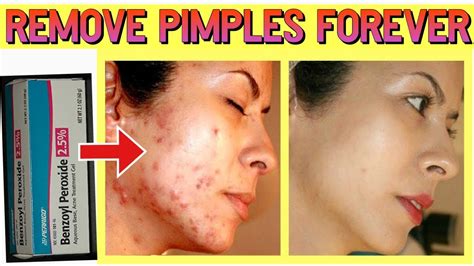 How To Remove Pimples Forever How To Remove Acne Youtube