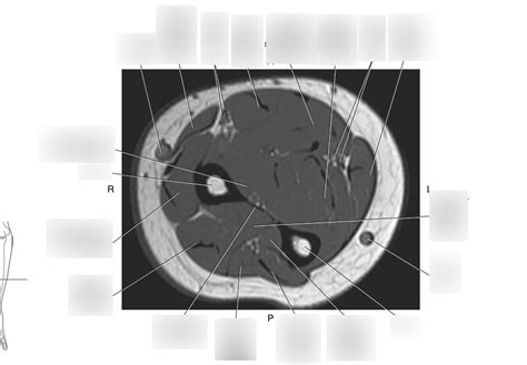 Fig 998 Axial T1 Weighted Mri Of Mid Forearm Muscles Right Arm