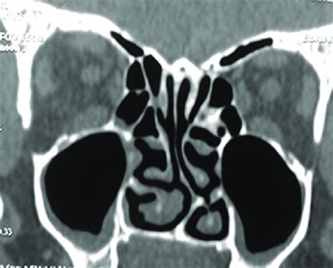 Computed Tomography Scan Of The Nose And Paranasal Sinuses Showing Left