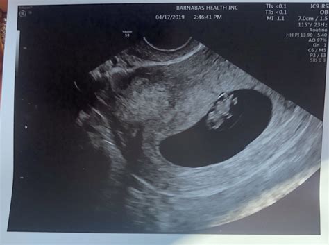8 Weeks Ultrasound Does It Looks Normal November 2019 Babies