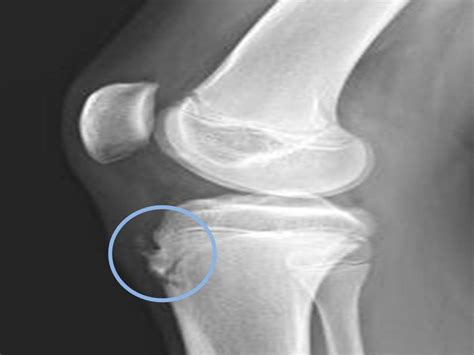 Osgood Schlatter Disease Tenderness In The Knees Greg Robinson