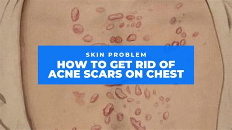 9 Easy Ways How To Get Rid Of Acne Scars On Chest Natural And Medical