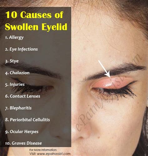 10 Causes Of Swollen Eyelid And Its Treatment