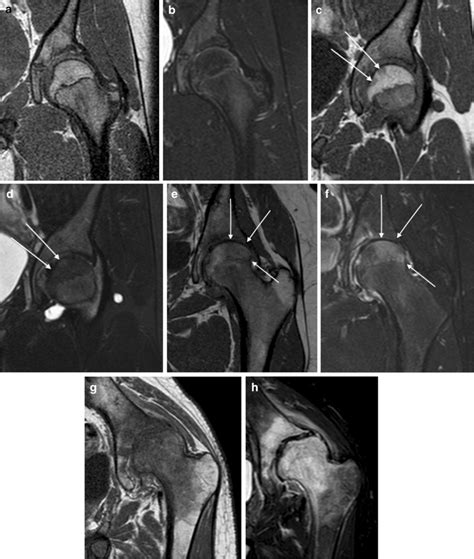 Femoral Head Bone Marrow Edema Demonstrated On Mri Of The Left Hip In