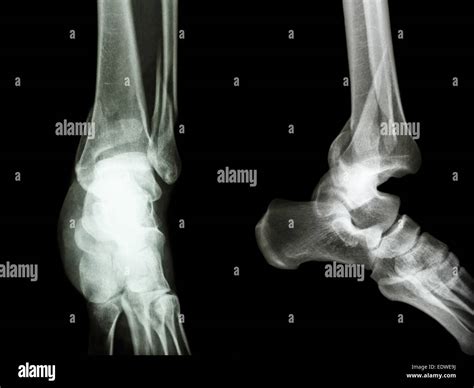 Película X Ray Tobillo Aplateral Mostrar Fractura Distal De Tibia Y