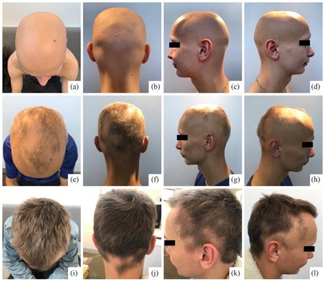 Clinical Course Of Alopecia Areata On The Scalp At Baseline A B C