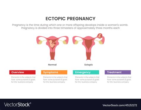 Ectopic Pregnant Or Pregnancy Infographic Concept Vector Image