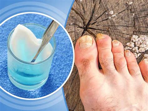 I've had it for years want to clear it up its white and does salt water help? How to use hydrogen peroxide for nails fungus - lifealth