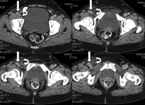 Acute Perforated Appendicitis In Femoral Hernia Sac Ct Imaging