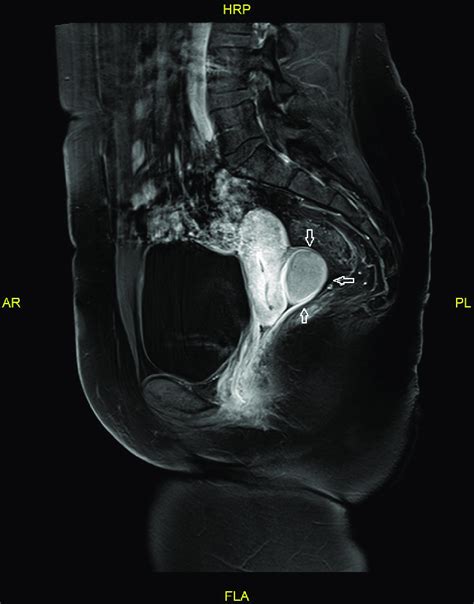 Sagittal View Of The Abdomen And Pelvis On Mri T1 Weighted Imaging With