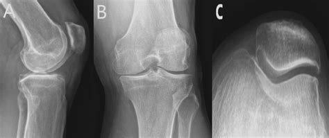 Cureus Selective Iliotibial Band Release For Iliotibial Band Traction