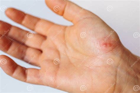 Herpes On Palm Womanand X27s Hand Stock Image Image Of Enterovirus