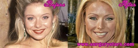 Kelly Ripa Plastic Surgery Botox Before And After