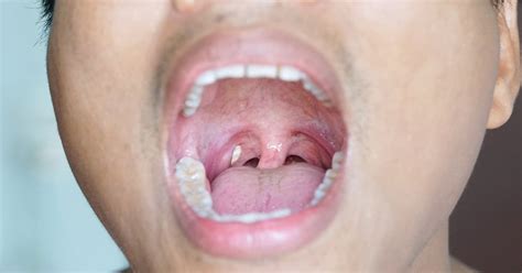 Do Tonsil Stones Cause Bad Breath Smartmouth