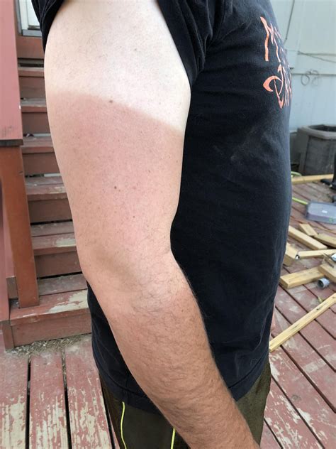 My Fiance Has Three Shades Of Skin On His Arm Right Now R