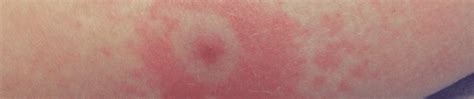 The Characteristic Bullseye Rash For Lyme Disease Innatoss