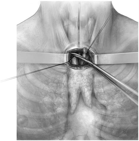 Video Assisted Transcervical Thymectomy Operative Techniques In