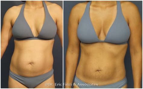 Fat Transfer With Liposuction Surgery In Chevy Chase Maryland