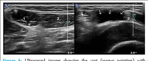 Figure From Intratendinous Ganglion Cyst Of The Semitendinosus Tendon First Reported Case And