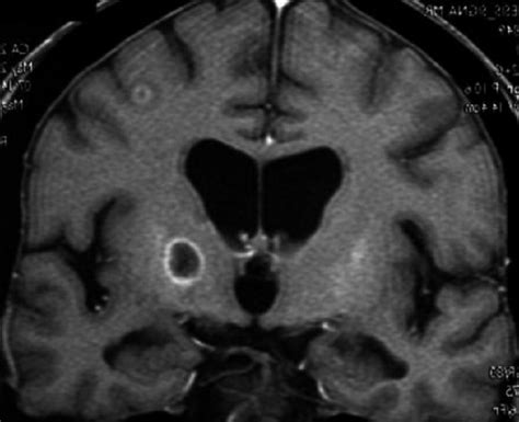 T1 Weighted Contrast Enhanced Coronal Mri Hypointense Nodular Lesion