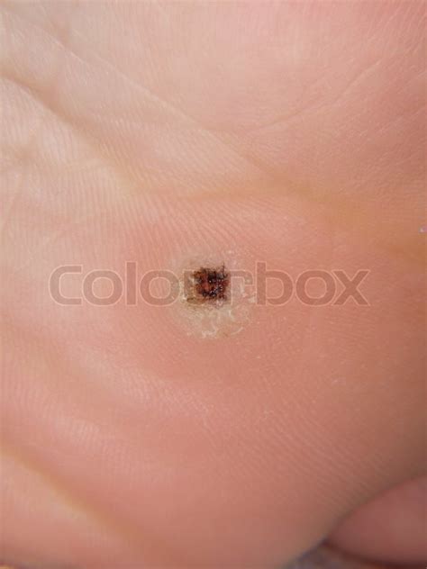 Black Spotted Callus Under Foot Stock Image Colourbox
