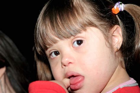 Discapacidad Y Salud Tratamiento Del Menor Con S Ndrome De Down