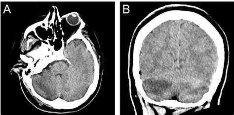 Figure 1 From Bilateral Cerebellar Hemorrhagic Infarcts As An Early