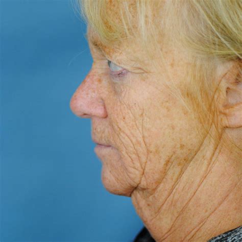W Plasty Neck Lift Before And After Thomas Funcik Md