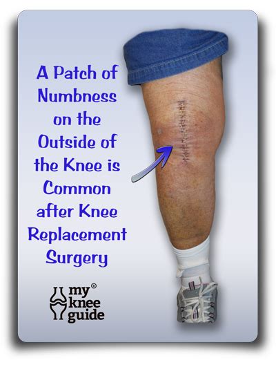 Knee Pain After Knee Replacement Surgery It Is Common To Have A Patch
