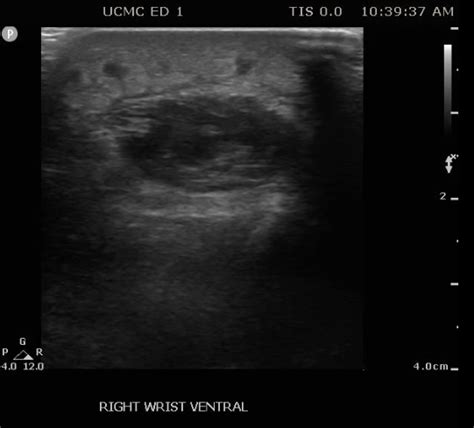 Us Soft Tissue Deep Abscess Of The Neck Ultrasound Of The Month