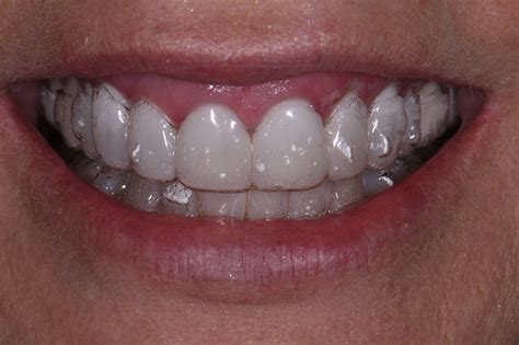 Invisalign Clear Aligners Auckland Nz