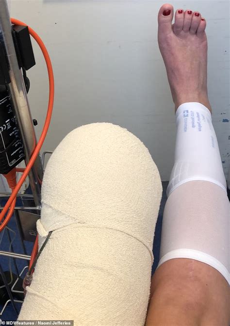 Physiotherapist Has Leg Amputated After 17 Surgeries To Try And Save