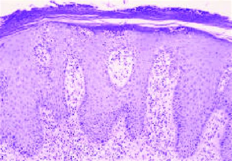 Histopathology Of The Lesion Psoriasiform Hyperplasia Of Epidermis
