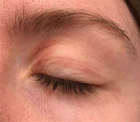 Skin Concerns Dry Patch On Eyelid Wont Budge Dry Eyelids Dry