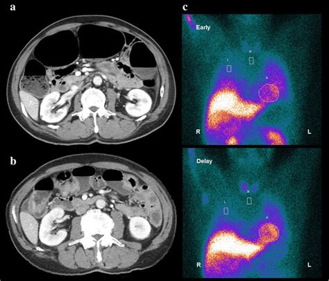 Abdominal Contrast Enhanced Computed Tomography 13 Days A And 83 Days