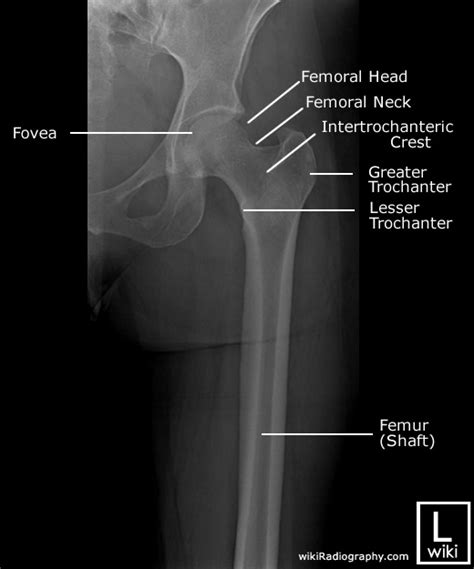 Femur Radiographic Anatomy Wikiradiography