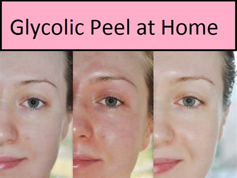 Light Chemical Peel Glycolic Peel At Home Chemical Peel Glycolic Peel