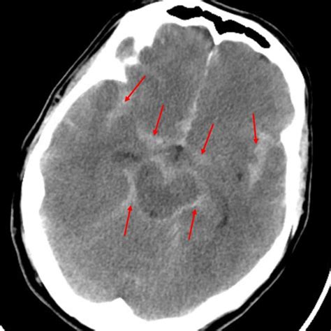 Subarachnoid Hemorrhage On Ct Head Download Scientific Diagram