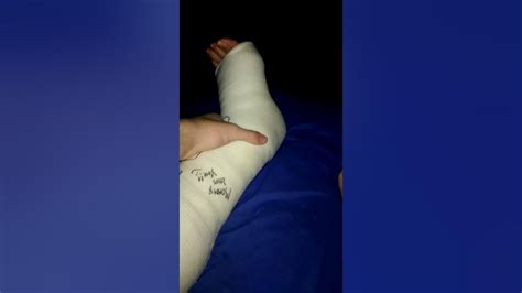 Broken Fibula Tibia And Torn Ligaments 2 Weeks After Surgery Youtube