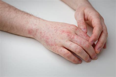 Allergy Red Itchy Rash On Male Hands On White Table Dermatological