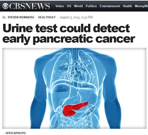 Pancreatic cancer can be hard to initially detect because of its vague symptoms. News in Proteomics Research: Potential urine test for ...