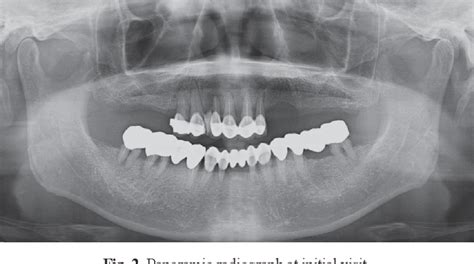 Figure 2 From Full Mouth Rehabilitation With Implant Supported Fixed