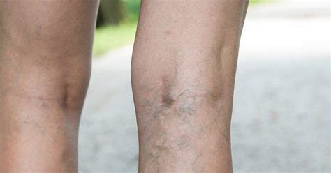 Skin Discoloration Changes And Vein Disease Vascular Vein Centers